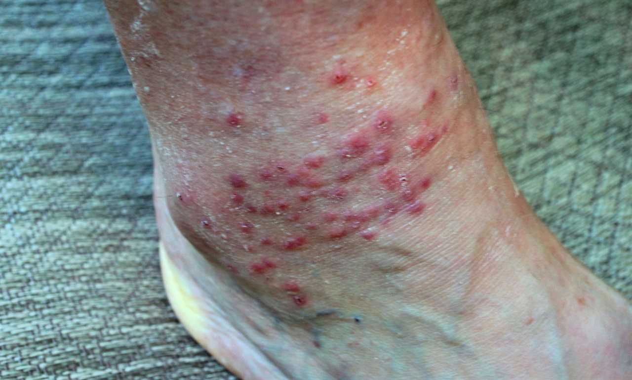 chigger bites on ankle