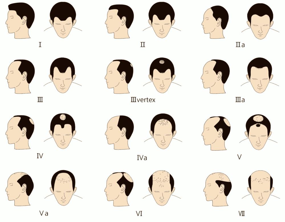 The Best Ways To Deal With A Receding Hairline